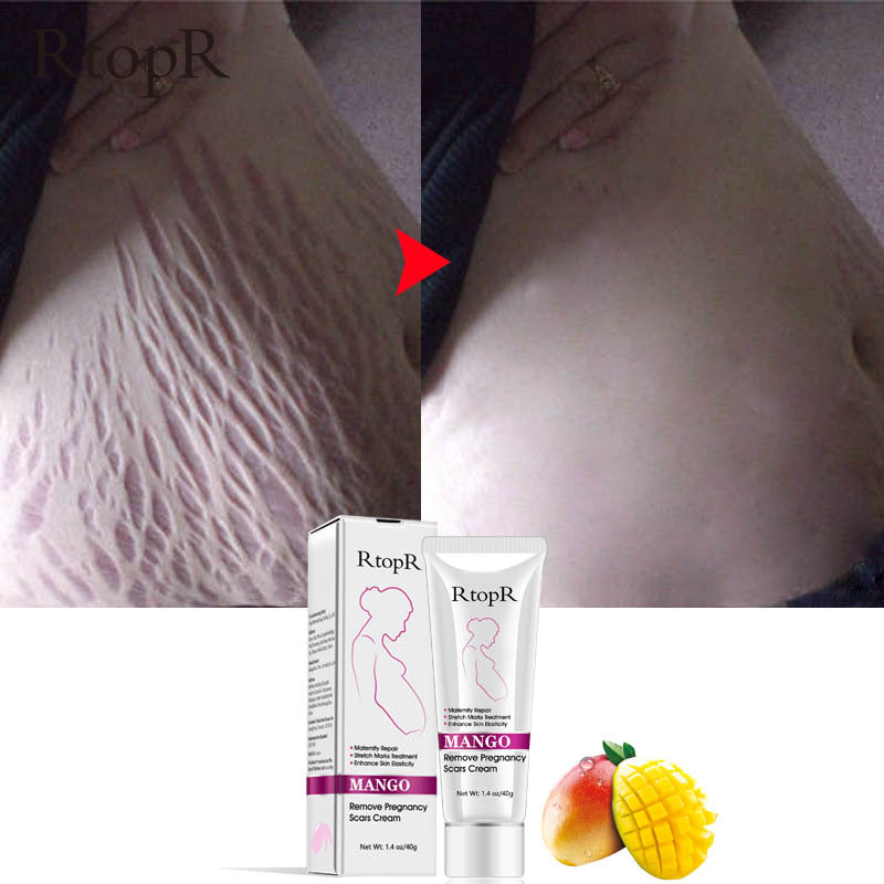 Mango Pregnancy Scar Cream