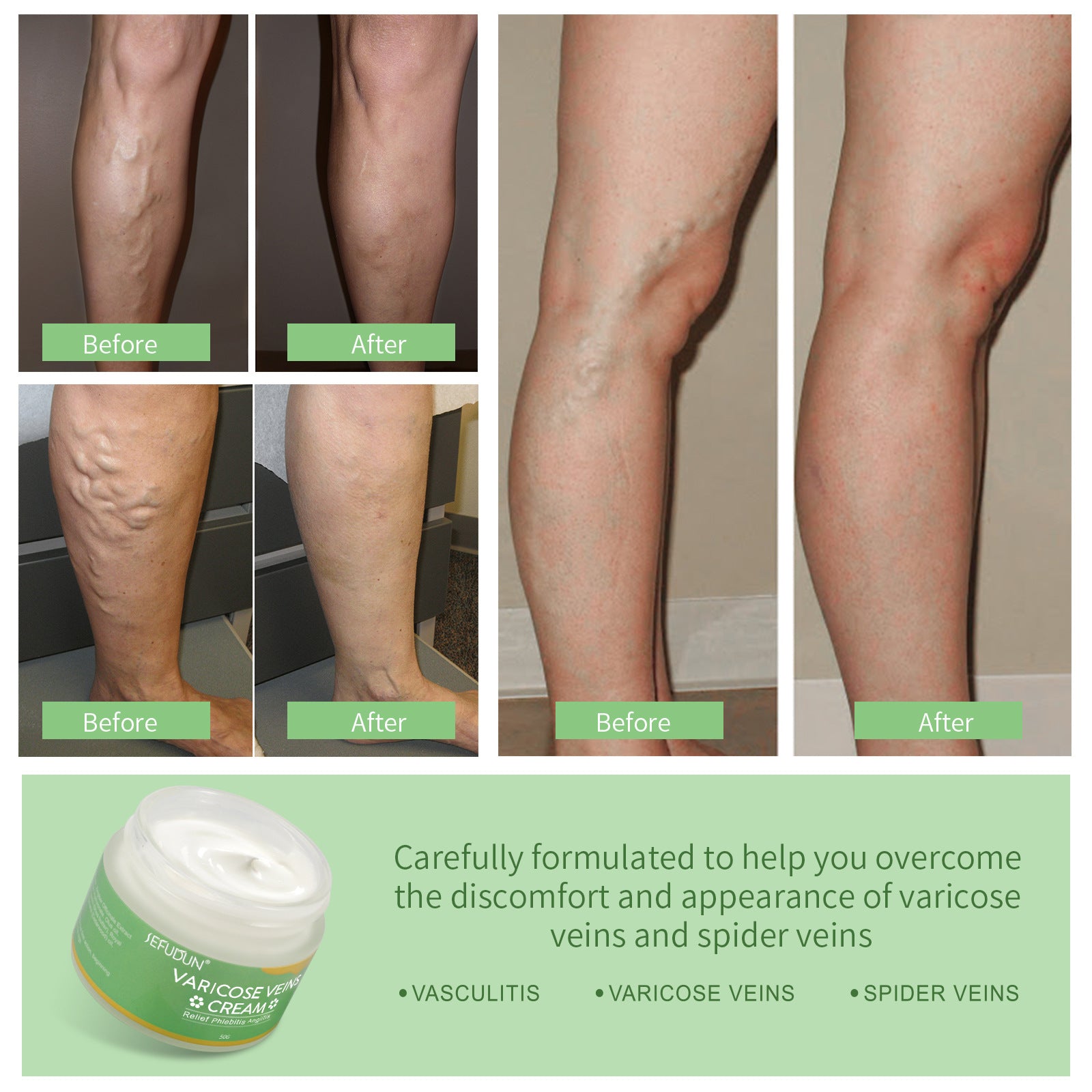 Varicose Vein Cream