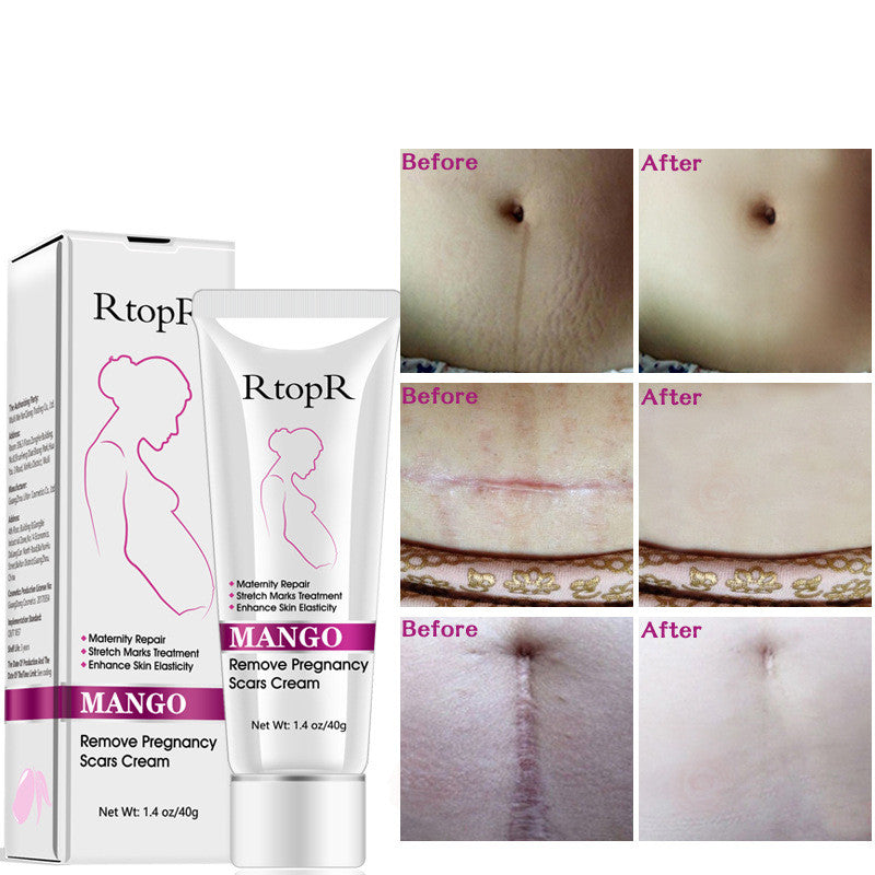 Mango Pregnancy Scar Cream