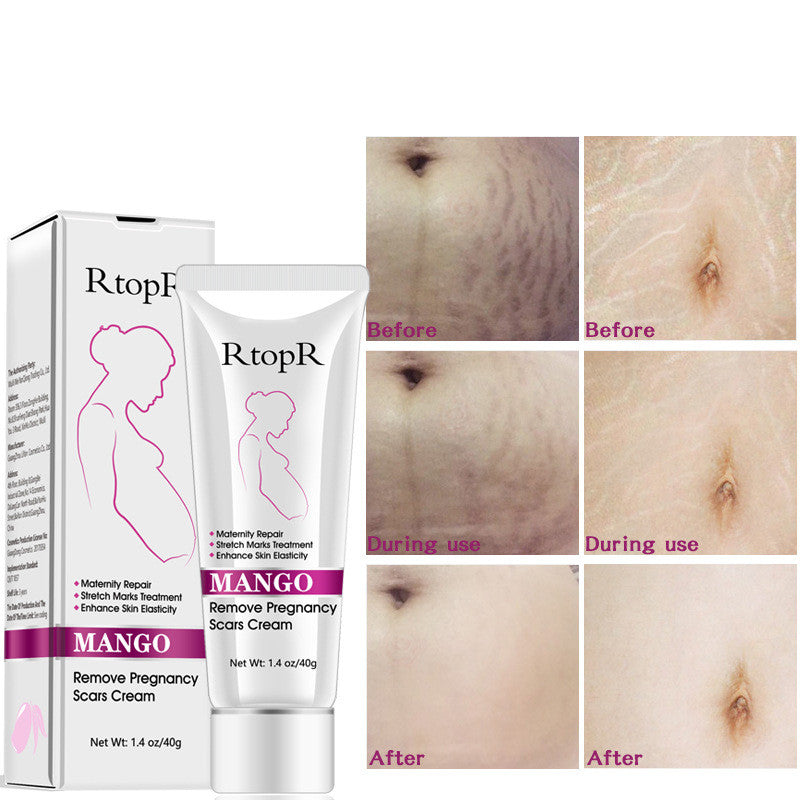 Mango Pregnancy Scar Cream