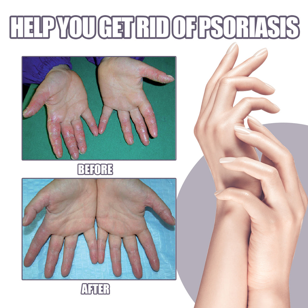 Psoriasis Itching Relief Spray