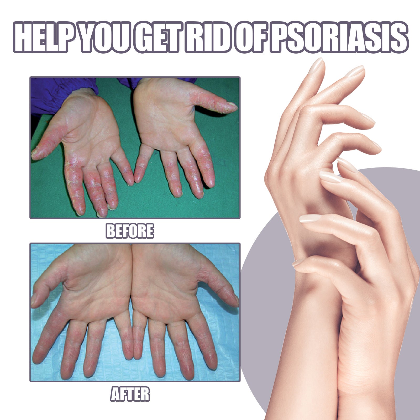 Psoriasis Itching Relief Spray