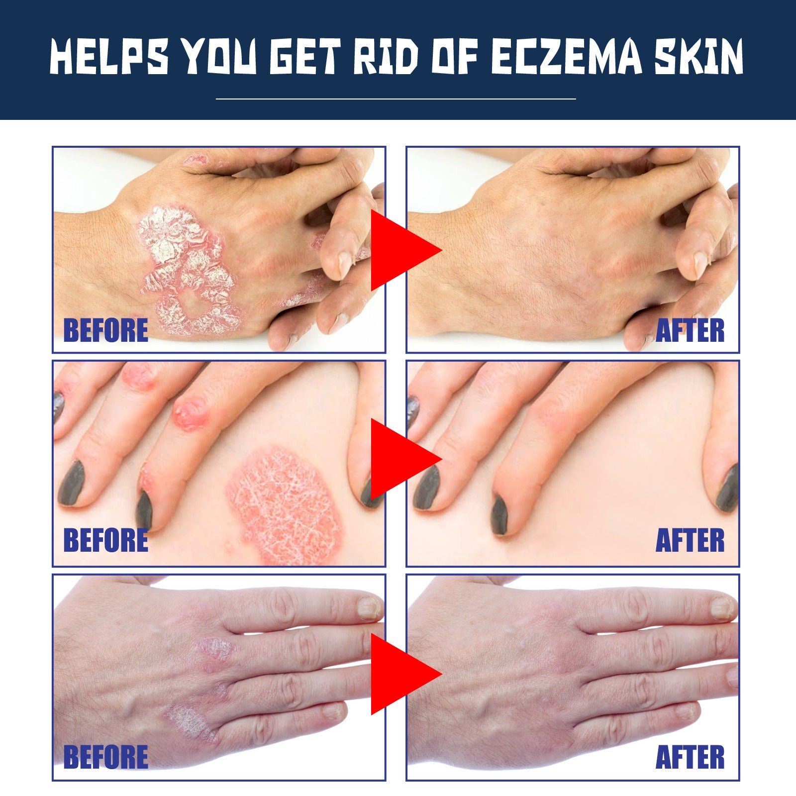 Psoriasis Soothing Spray