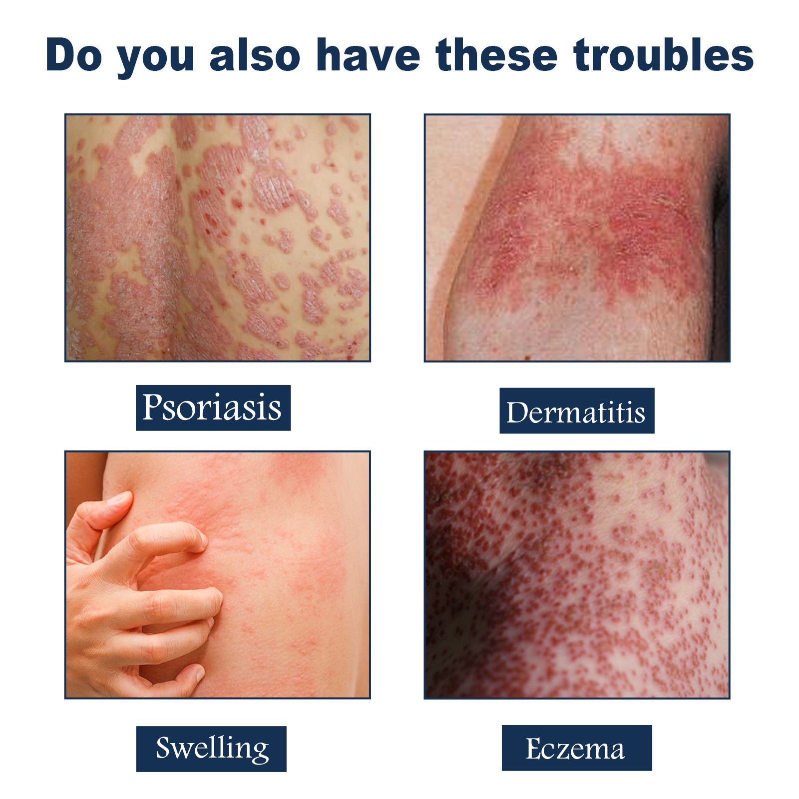 Psoriasis Soothing Spray