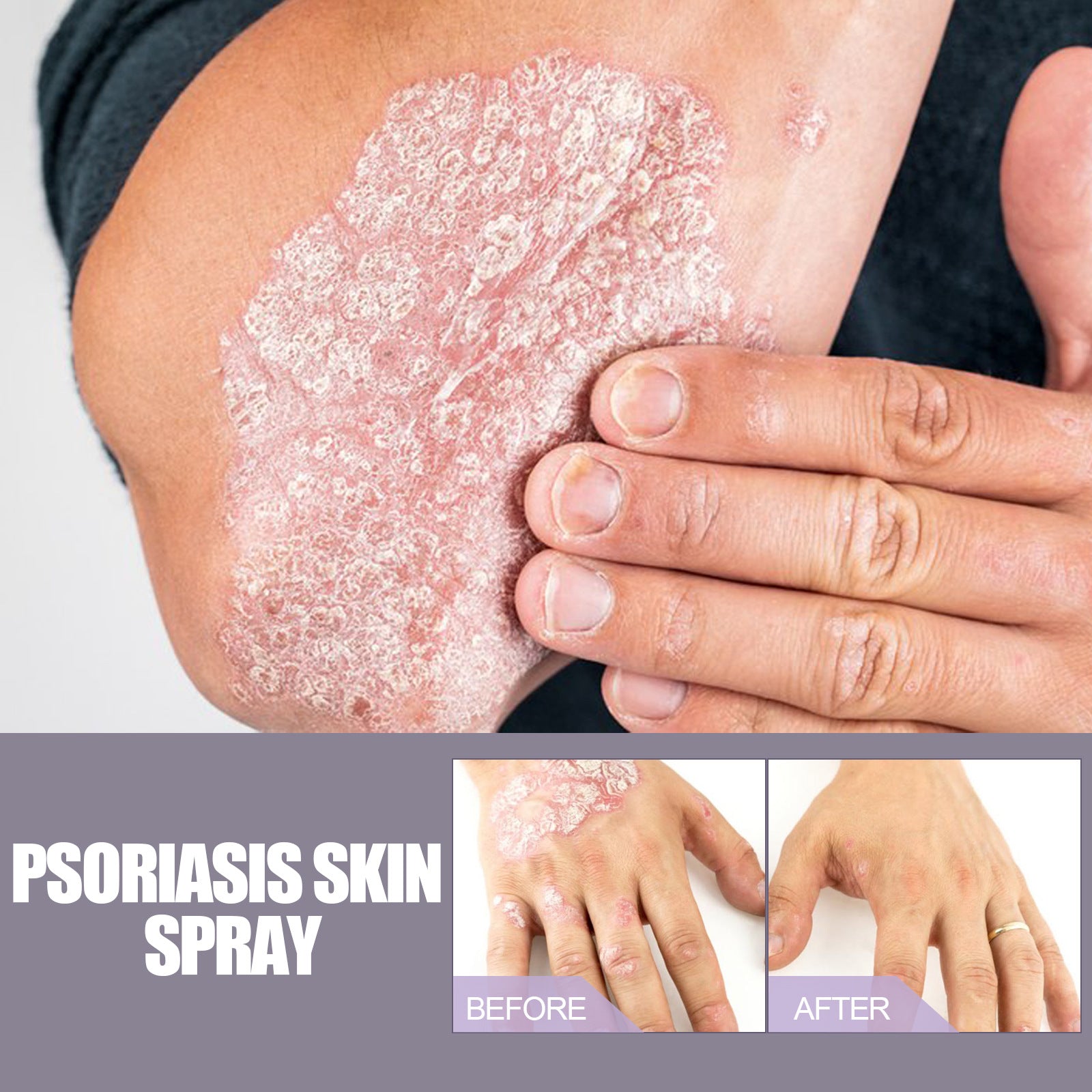 Psoriasis Itching Relief Spray